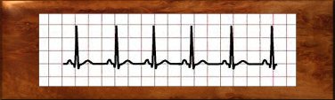 Normal Sinus Rhythm